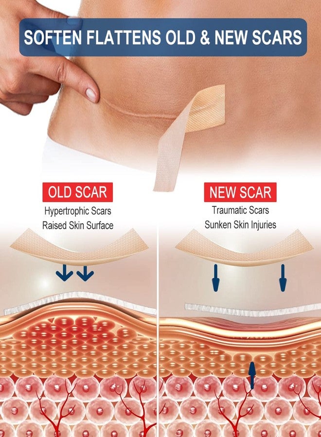MINGYITUO Silicone Scar Sheets Tape for Surgical Scars, C Section Scar Silicone Strips, Medical Grade, Reusable, Soften and Flattens Scars, Breast, Keloid, Professional Scar Patches. (1.6x115 Inch) - Image 2